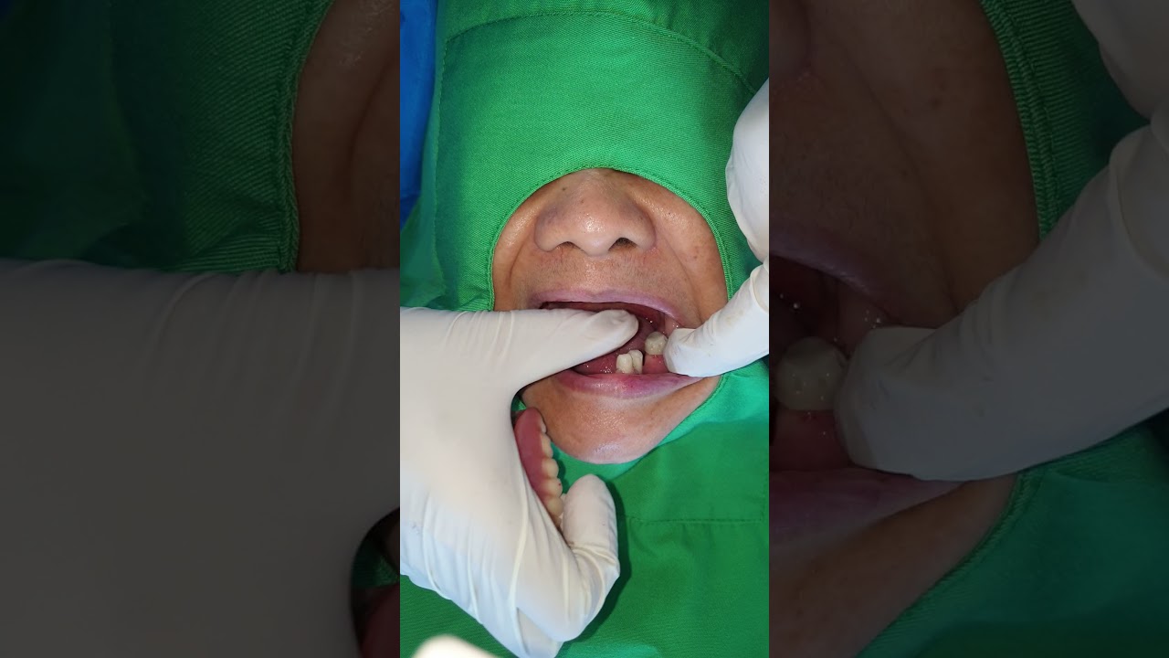 telescopic 3d printed dentures
