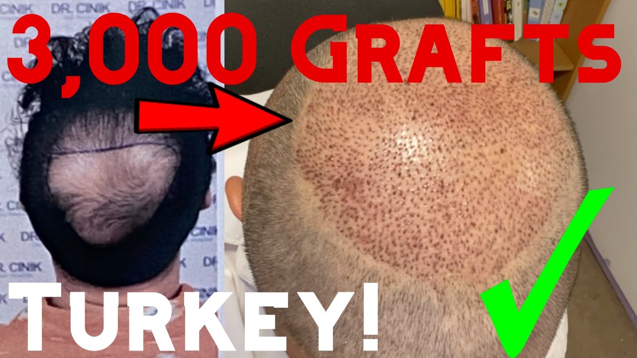My Second Hair Transplant in Istanbul, Turkey | 3,000 Grafts | Dr. Cinik Clinic |