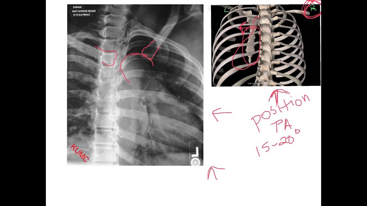 RAO sternum