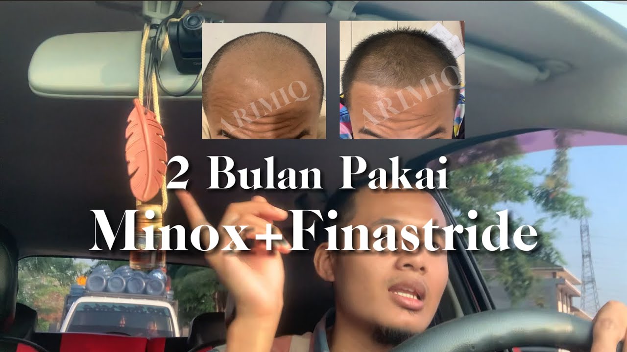 Pemakaian Jujur Obat Kebotakan selama 2 Bulan menggunakan Fabron (Minox+Finastride)