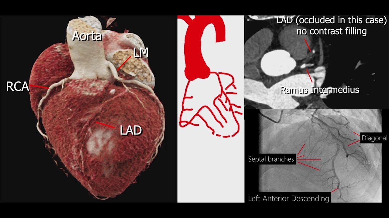Coronary Artery Anatomy & Imaging