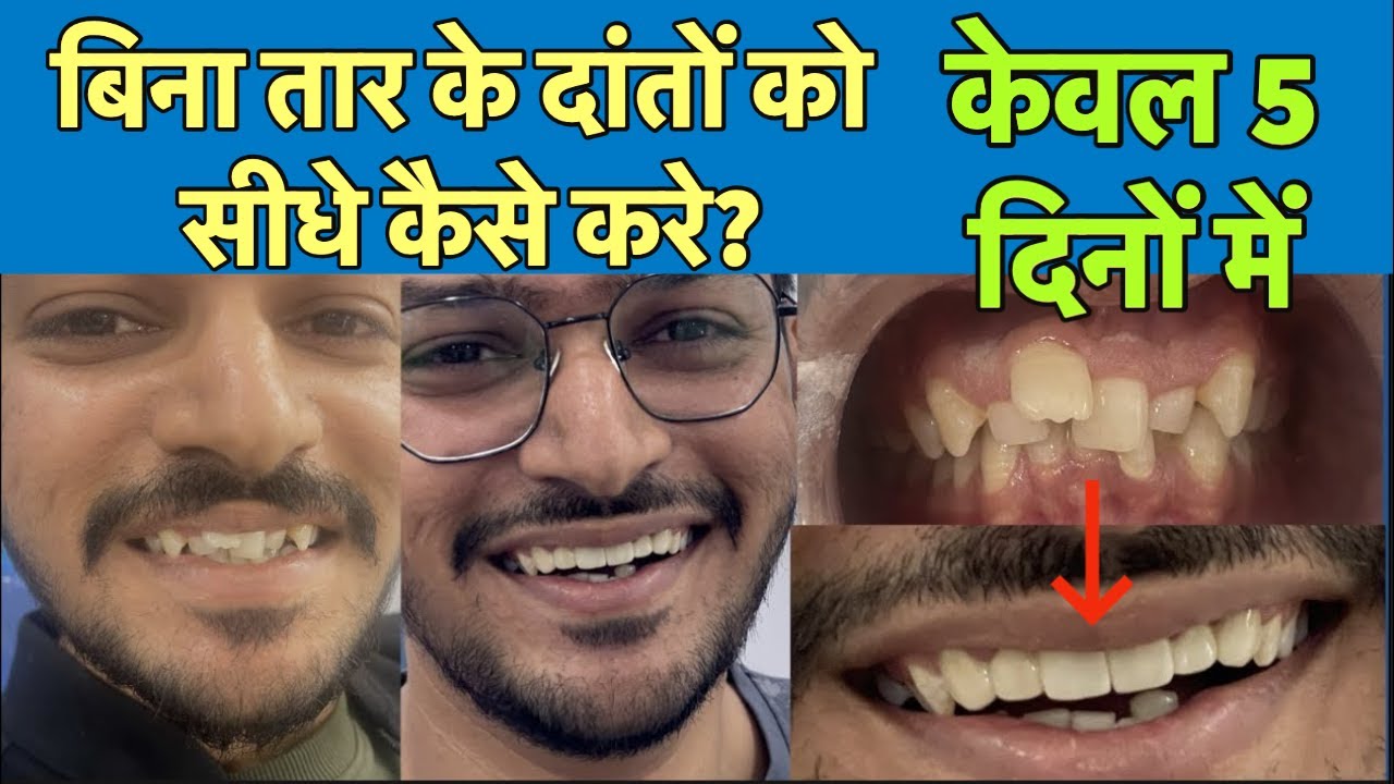 बिना तार के दाँत अंदर कैसे करें? | Irregular Teeth Correction in 5 Days | YouDent India Hospitals