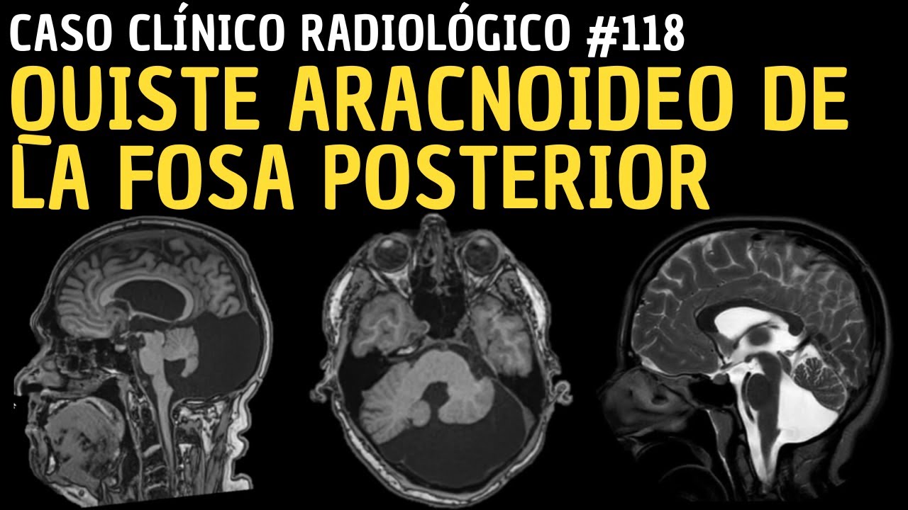 Caso clínico 118: Quiste aracnoideo de la fosa posterior.