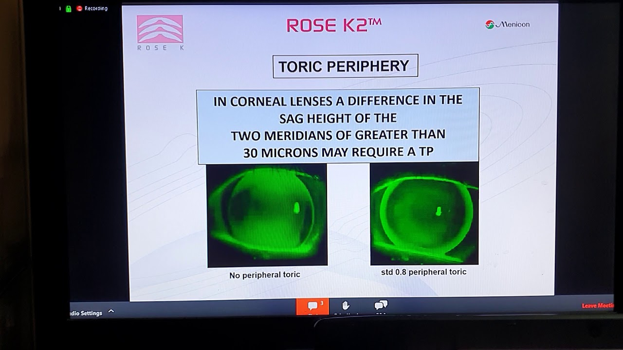 Advanced Options for Rose K2 Corneal Designs part 1