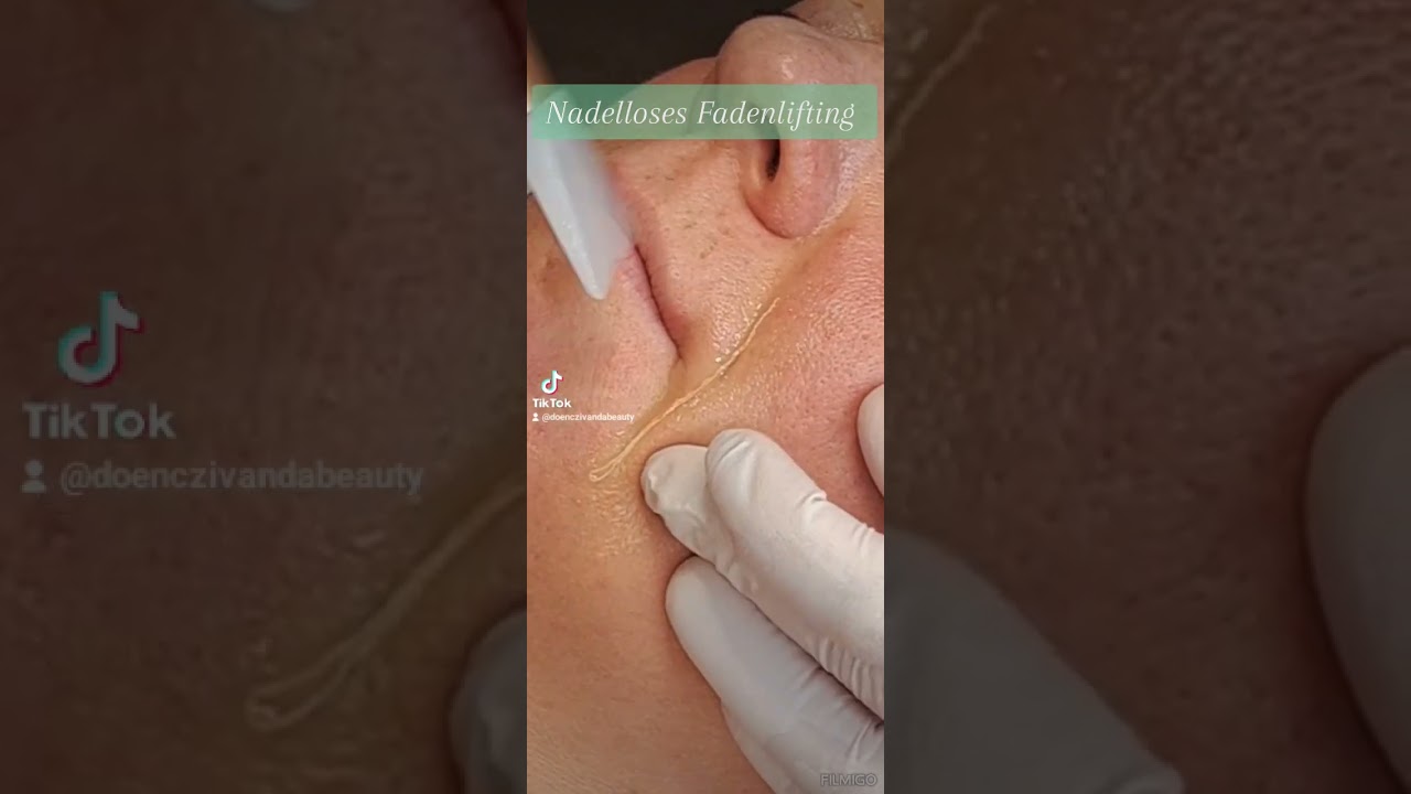 Nadelloses Fadenlifting