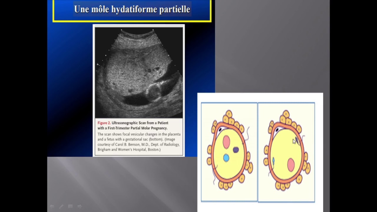 Maladies Trophoblastiques Docteur Yaici C.H.U Bab El Oued