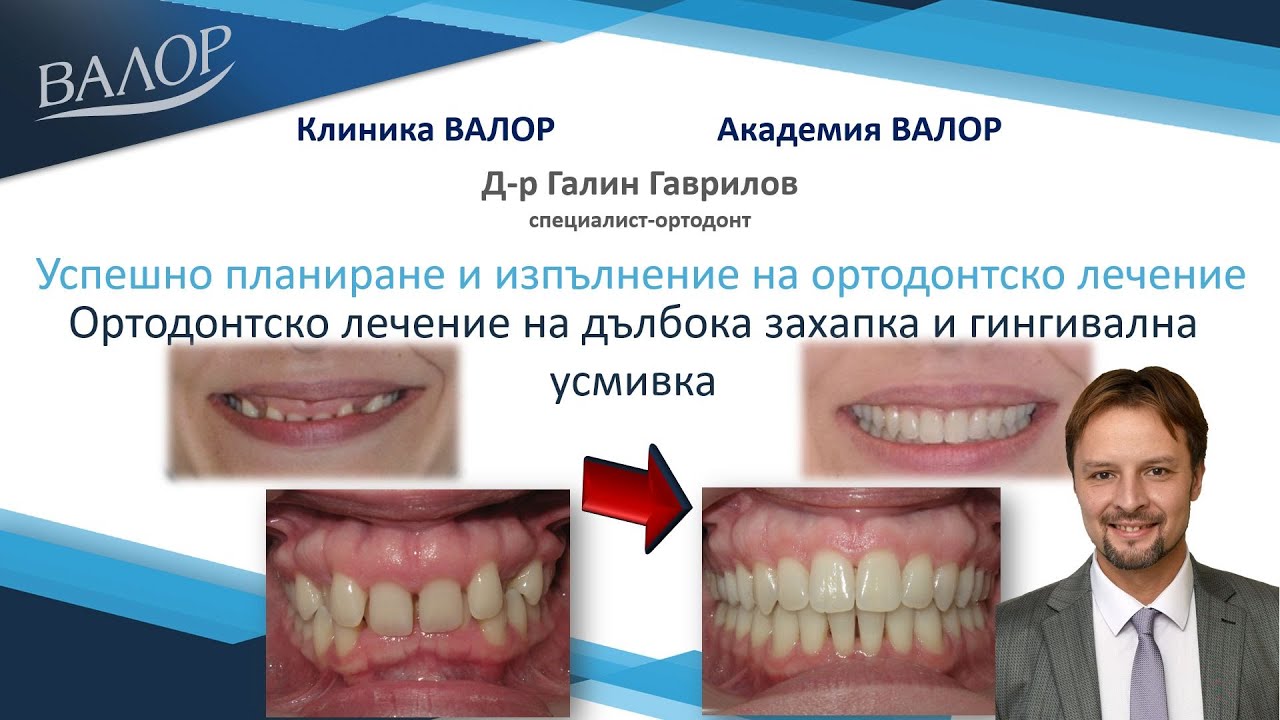 Лечение на втори скелетен клас с дълбока захапка и гингивална усмивка - #ортодонт #брекети