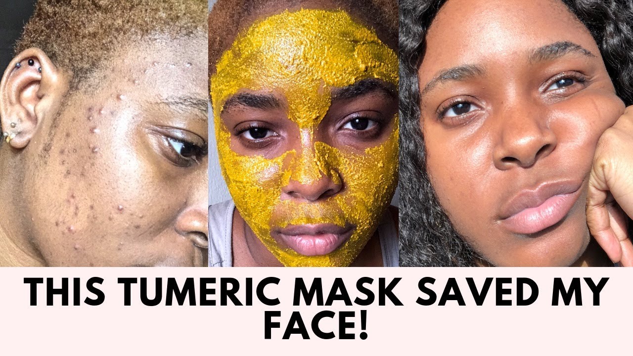 THE TUMERIC MASK THAT CLEARED MY ACNE SCARS AND HYPER PIGMENTATION!