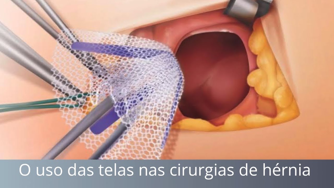 O uso das Telas nas cirurgias de Hérnia | Fernando Eyer