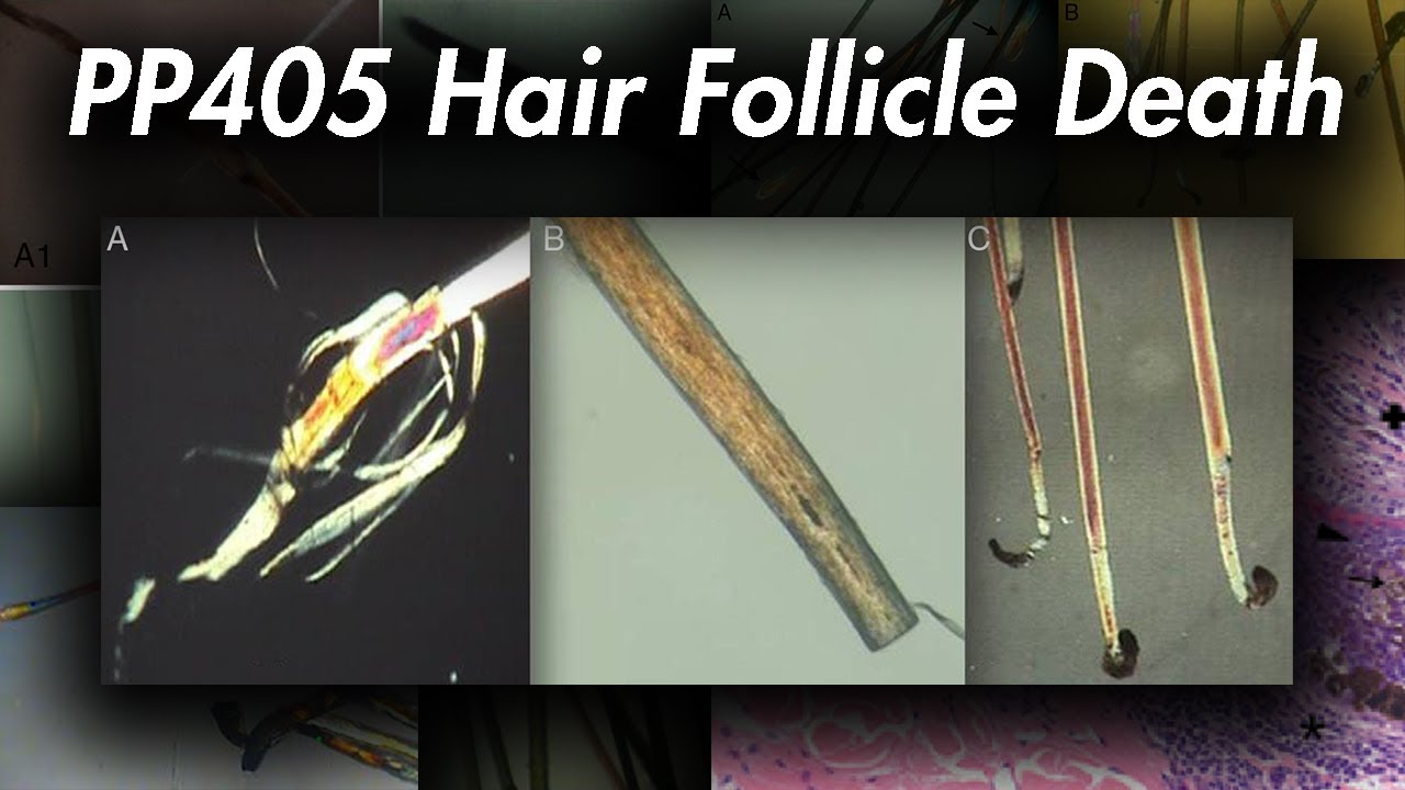 PP405 не работает: гибель волосяного фолликула? | Злоупотребление системой ISR