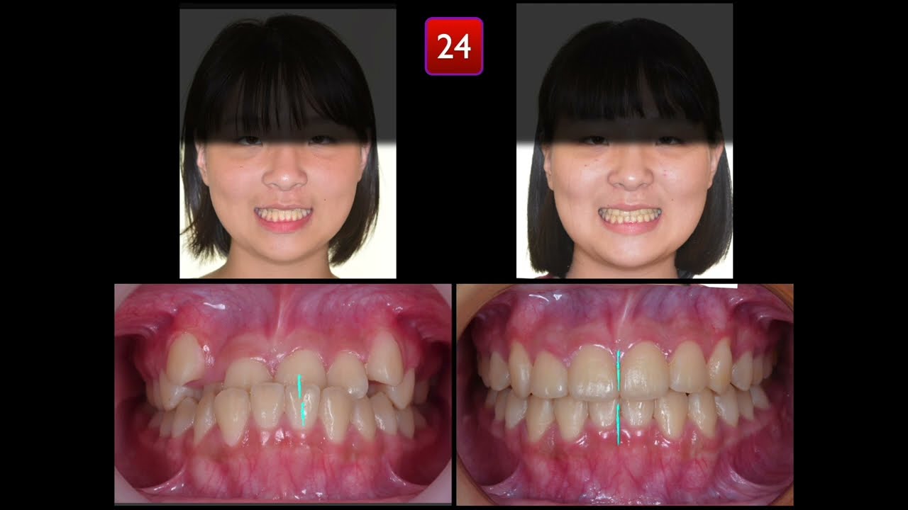 Non-extraction Treatment of Pseudo Class III malocclusion｜【Chris Chang Ortho】CC706