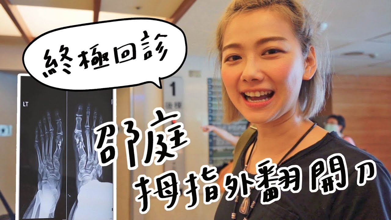 全台手播【邵庭Vlog】#9 邵庭拇指外翻回診  