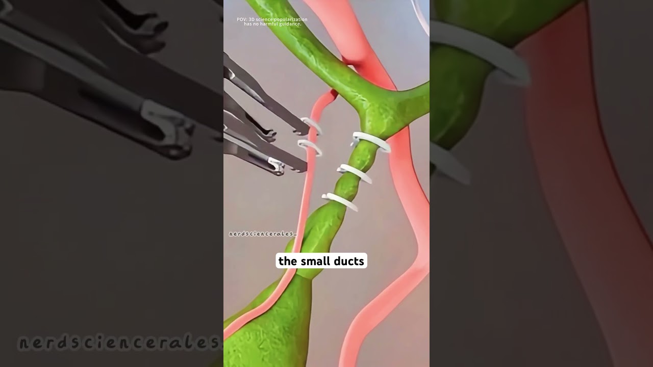Cholecystectomy surgery animation 