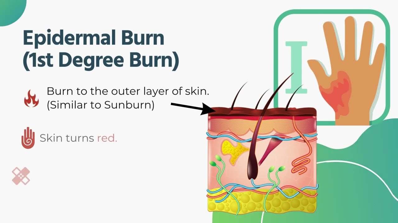 Burns: Four Degrees