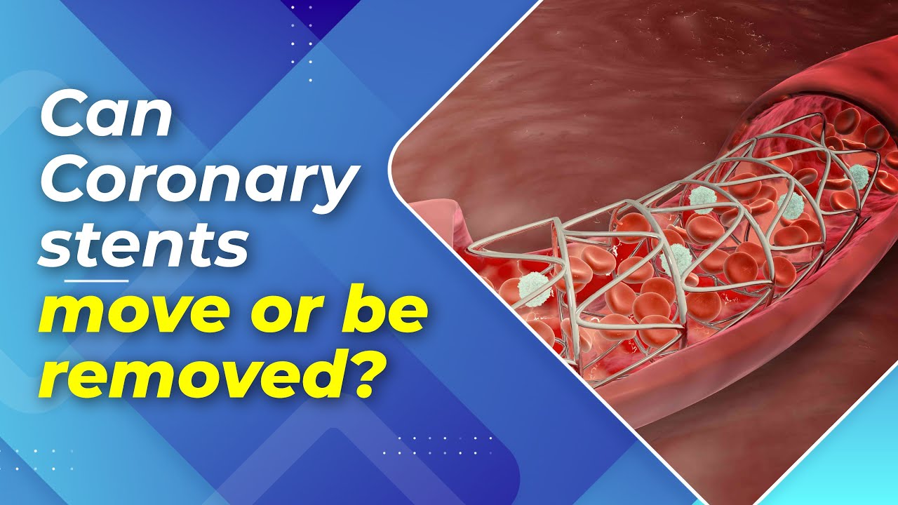 Can Coronary Stents move or be removed?