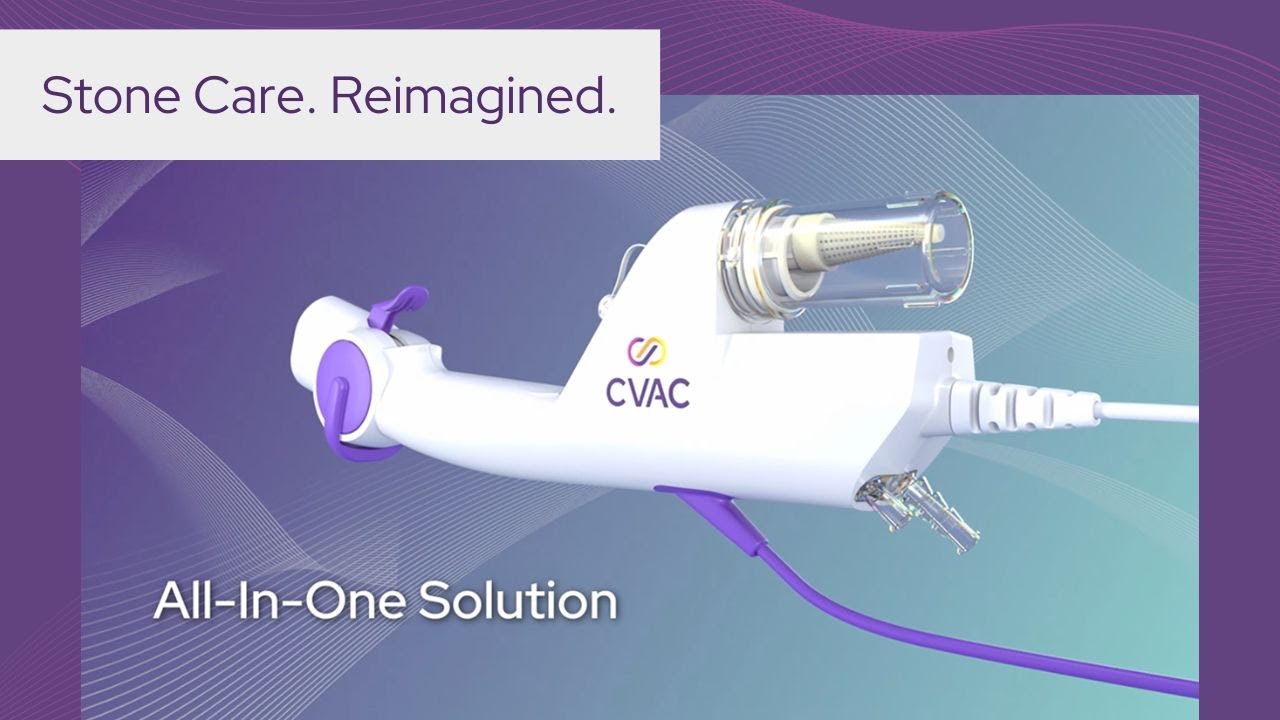 Calyxo CVAC System: Revolutionary Kidney Stone Treatment
