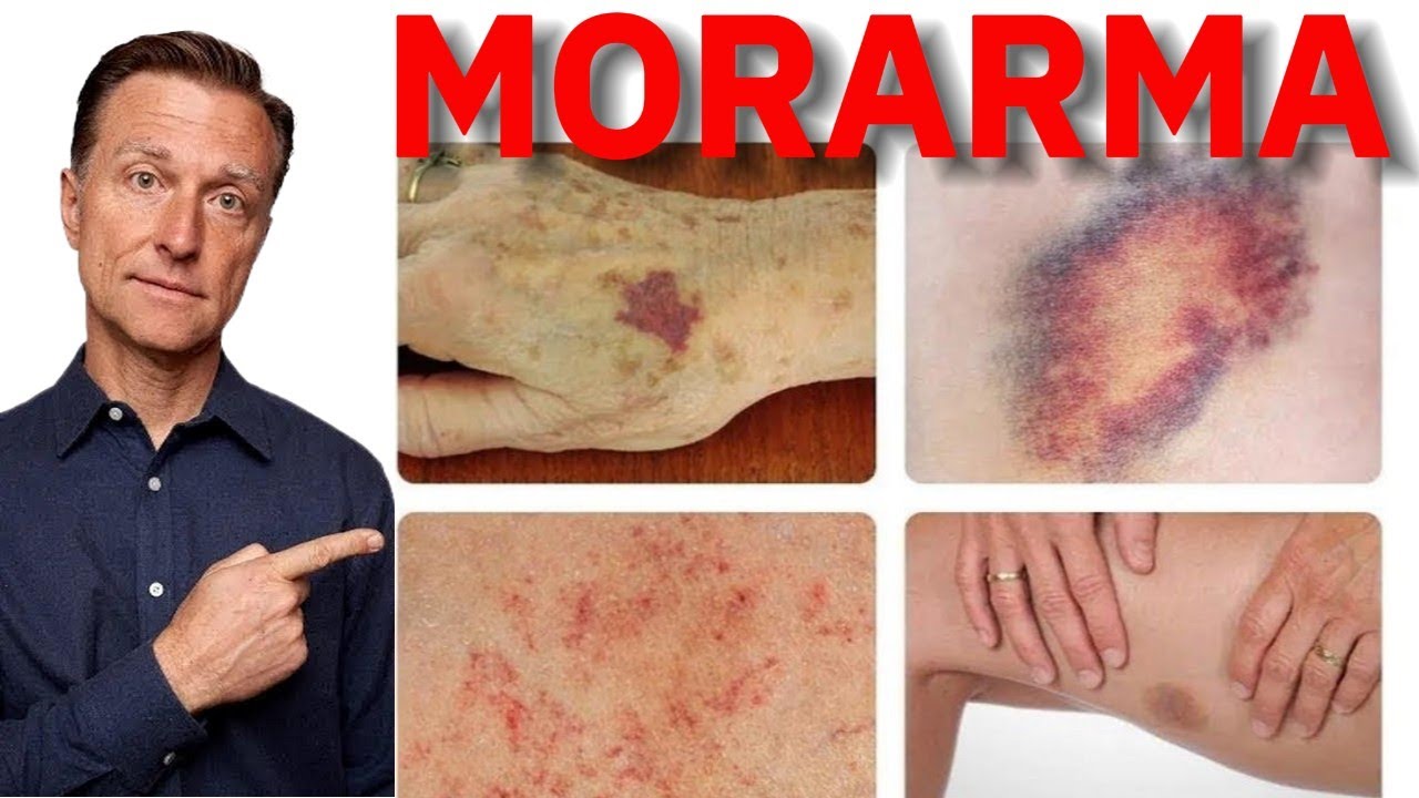 Yaralanma Olmaksızın Oluşan Morlukların Derin Nedenleri | Dr. Berg T&uuml;rk&ccedil;e