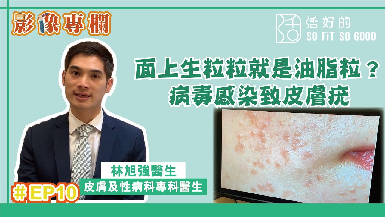 【影像專欄】面上生粒粒就是油脂粒？皮膚疣原來與HPV病毒有關！ | 皮膚及性病科EP10 | 林旭強醫生