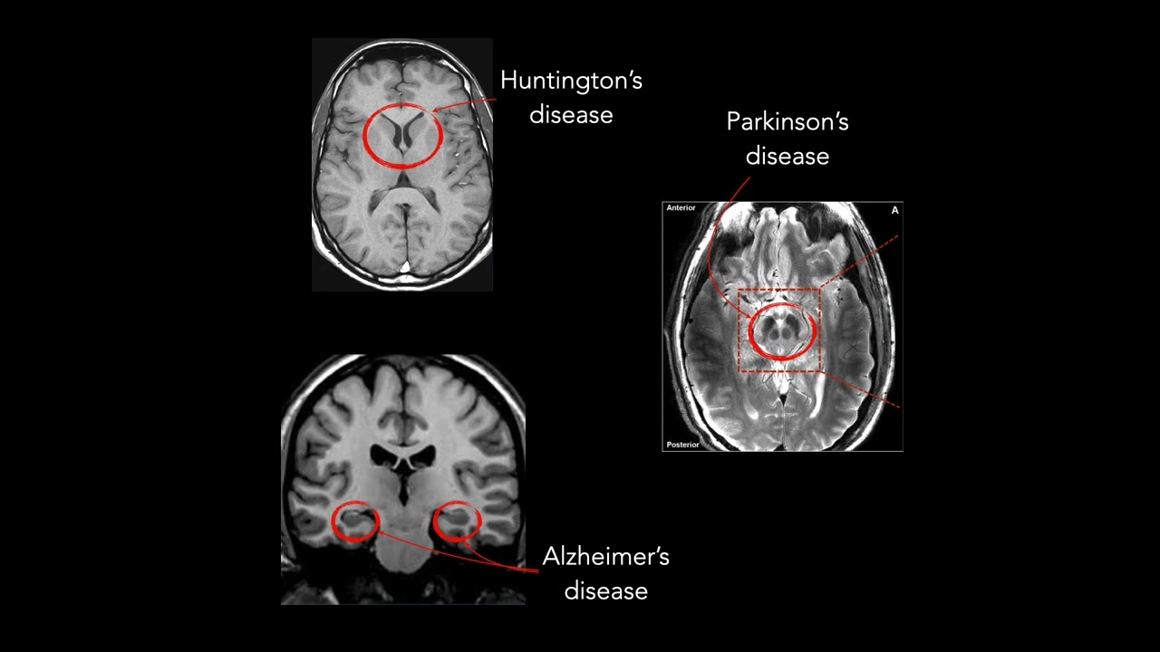 Genetics and Pathogenesis of Amyotrophic Lateral Sclerosis & Frontotemporal Dementia