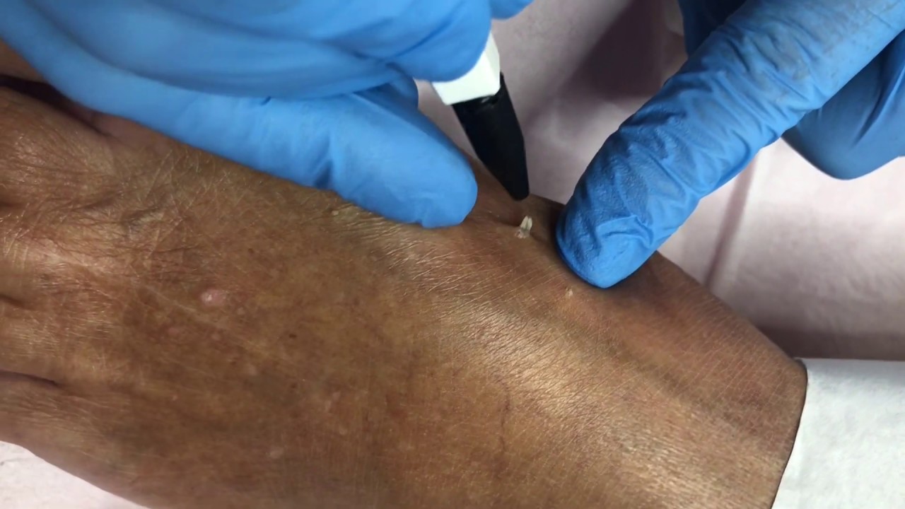 Wart Removal on the Foot | Appearances Aesthetics