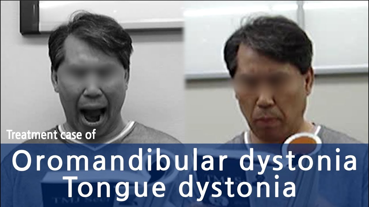Oromandibular dystonia / Tongue dystonia / 경구 하악 근긴장이상 사경증