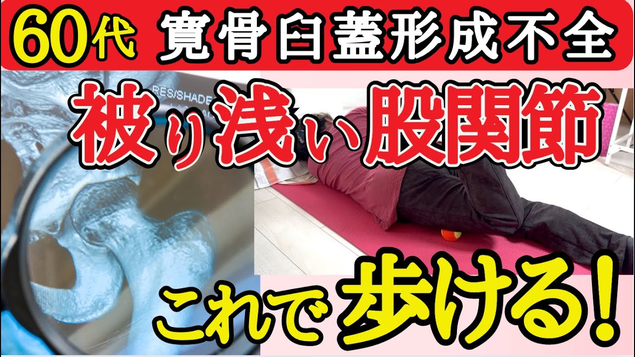 【臼蓋形成不全】骨頭の被りが浅くてもずれた軸を戻してサボり筋を呼び起こすと歩行がスムーズになります。