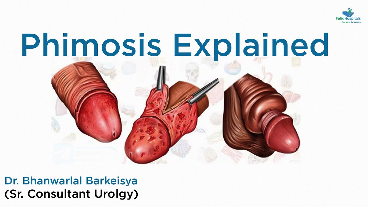 Understanding Phimosis and Balanitis: Causes, Symptoms, and Treatment Options | Dr. Bhanwarlal