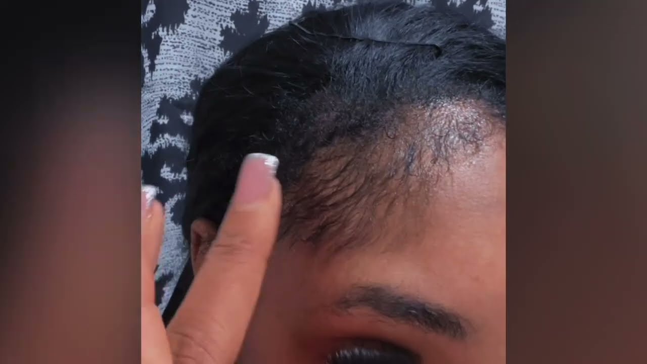 Using minoxidil to grow my edges