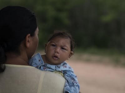 CDC: Zika Definitely Causes Severe Birth Defects