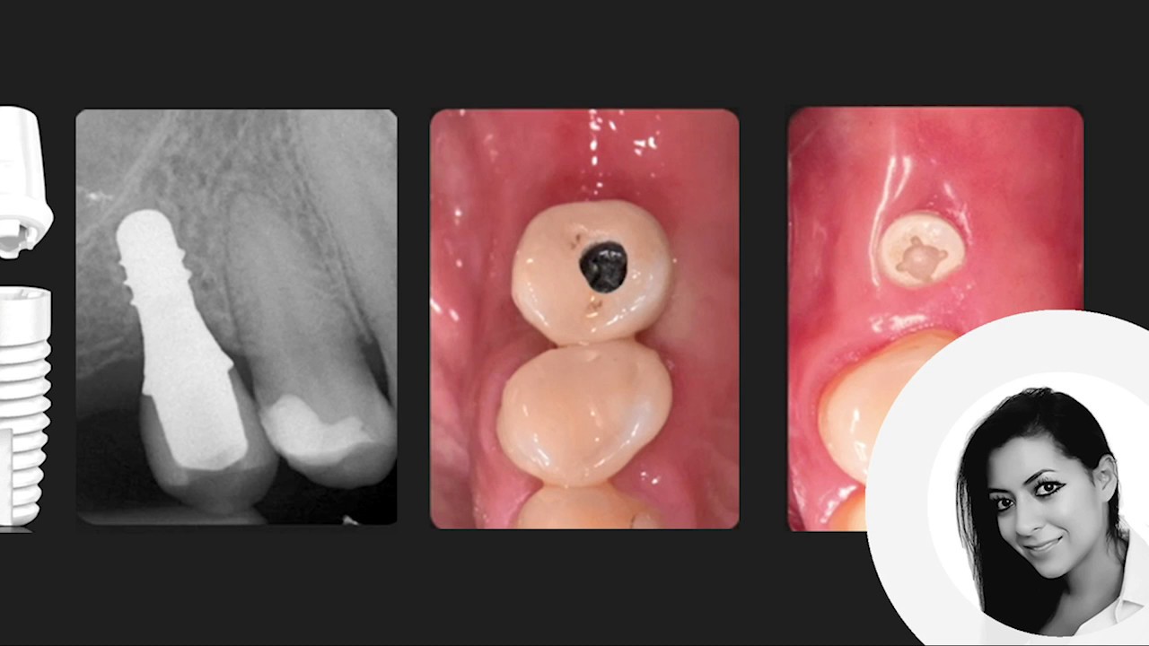 Why use ceramic dental implants?