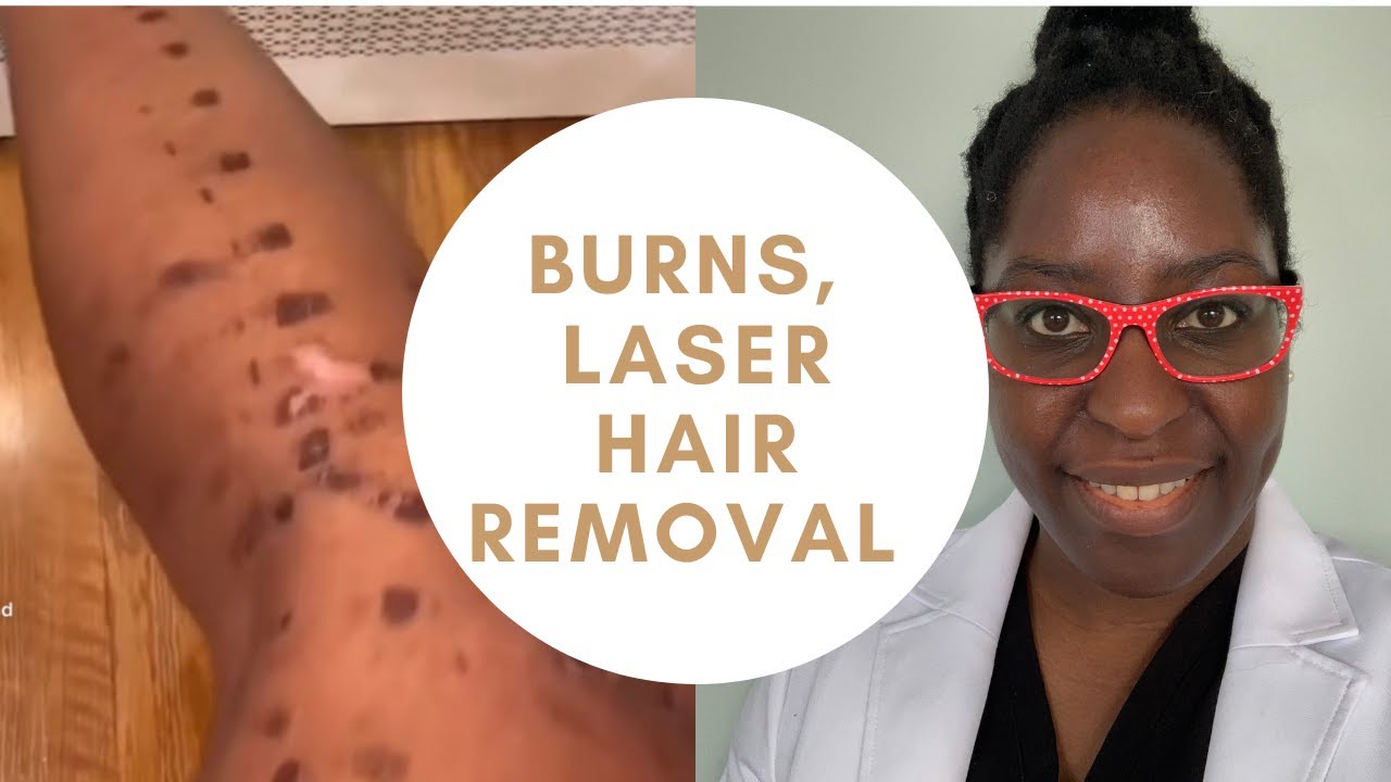 Burns, Laser Hair Removal, Laser hair removal for dark skin
