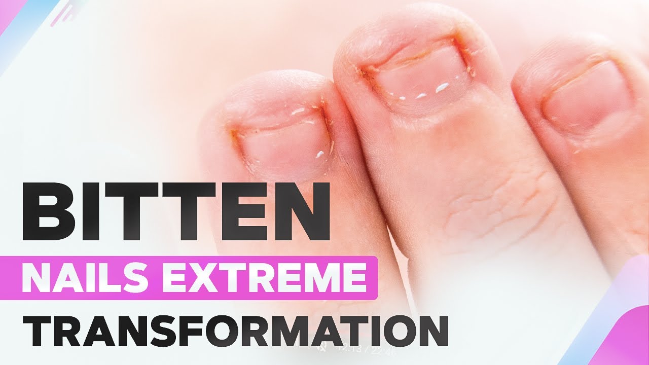 Преображение сильно обгрызенных ногтей | Влажная чувствительная кутикула | Акригель