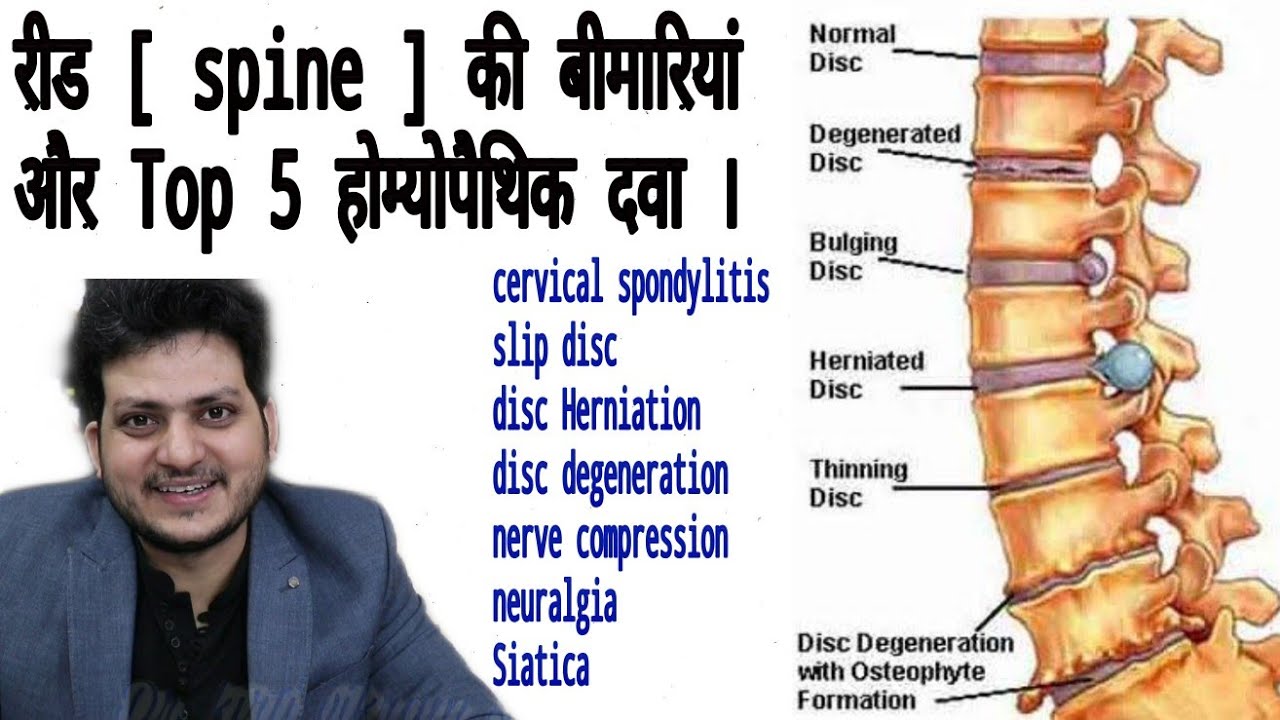 How to treat spine Diseases Back problem With Homeopathic medicine ?