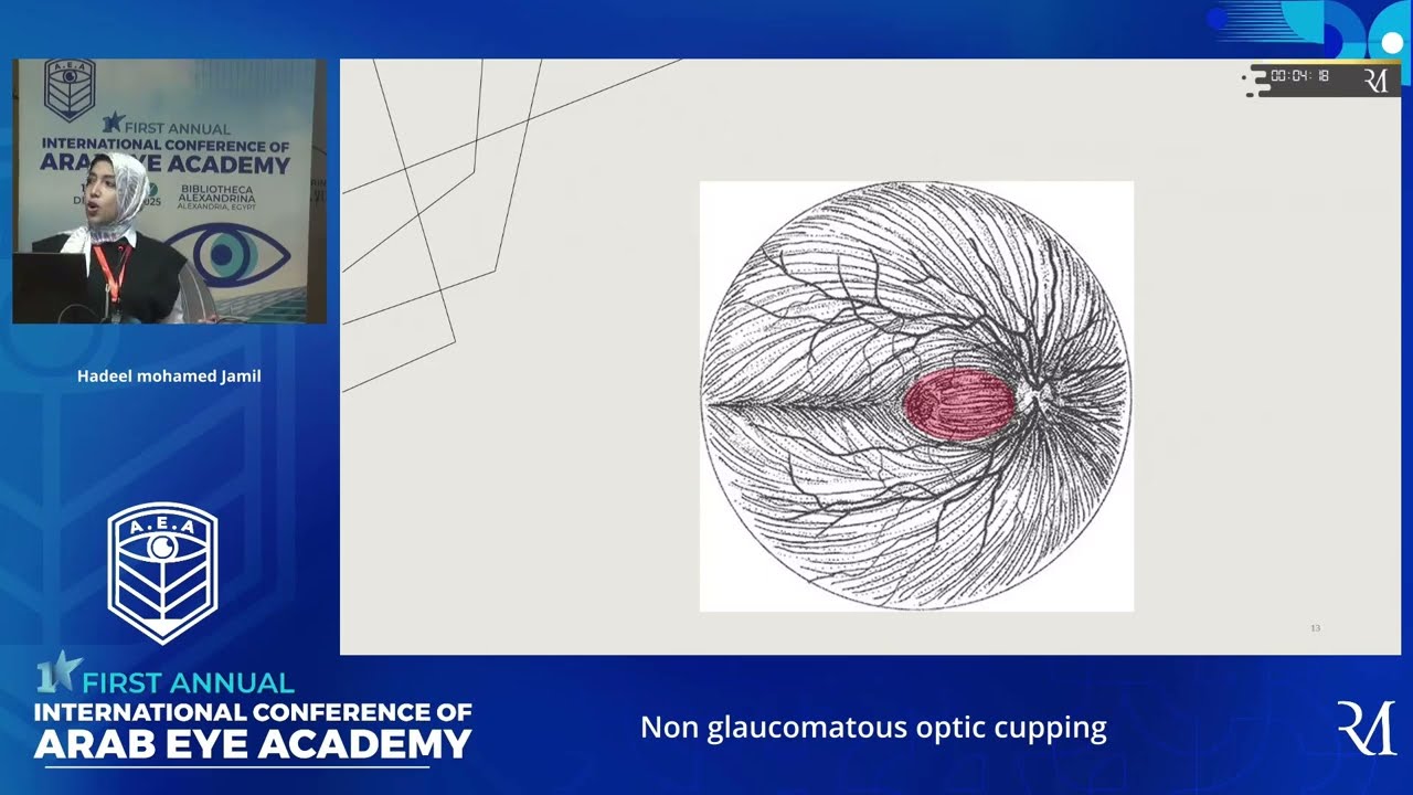 Non glaucomatous optic cupping, Dr. Hadeel Jamil