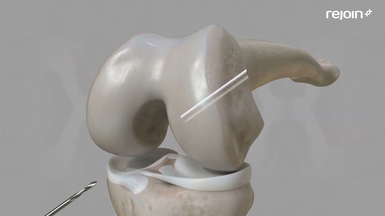 Rejoin Medical ACL reconstruction animation