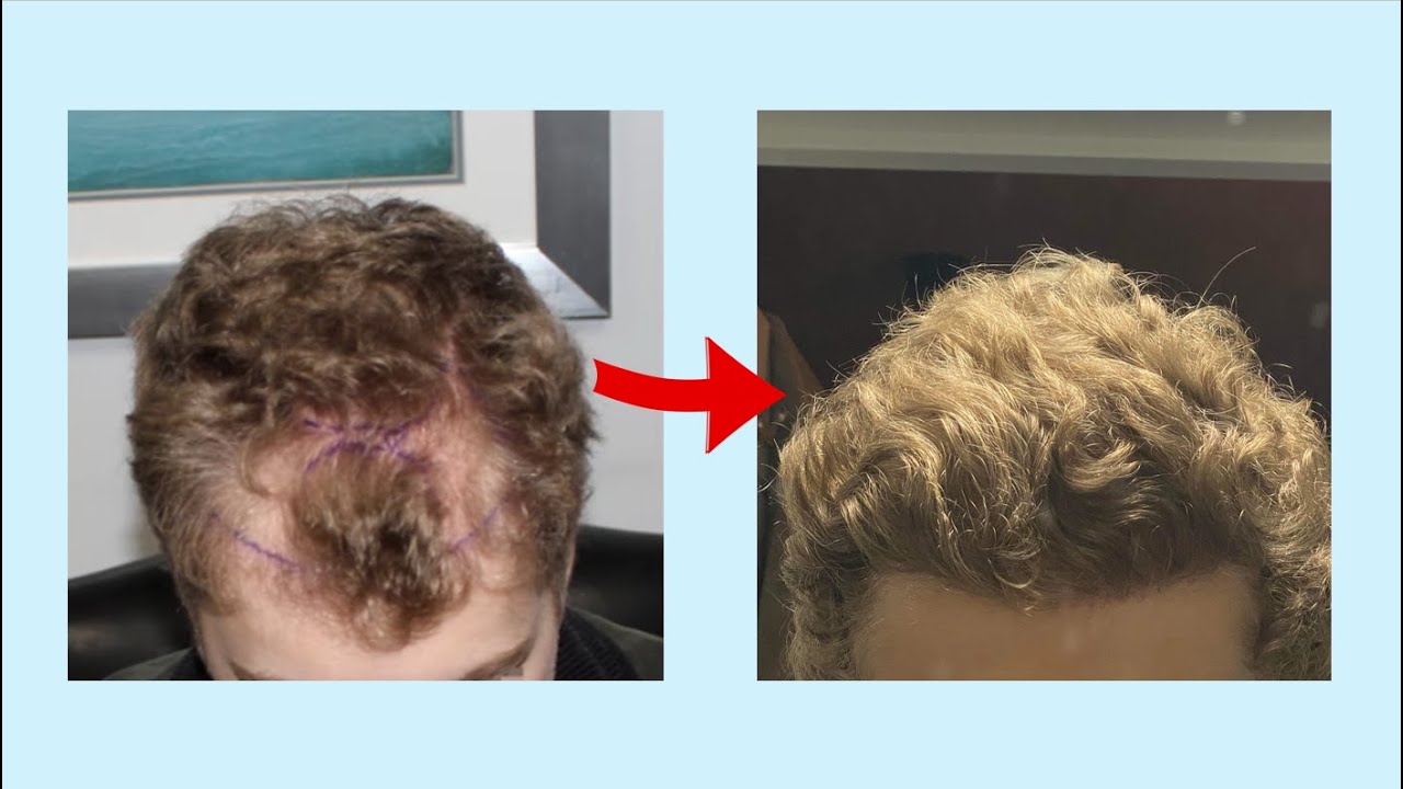 How I Got My Hairline Back