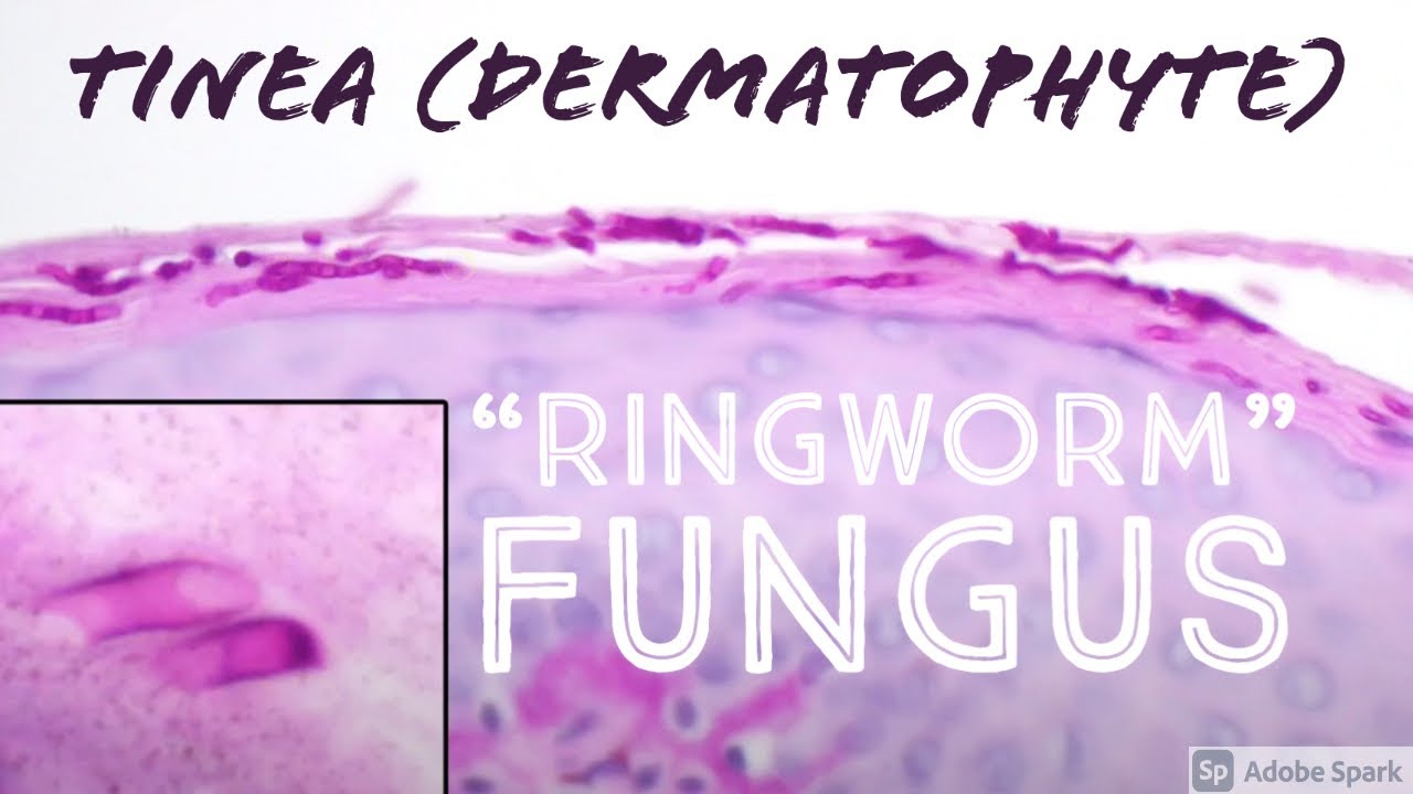 "Ringworm" under the microscope. It’s not a worm - it’s fungus! (tinea dermatophytosis pathology)