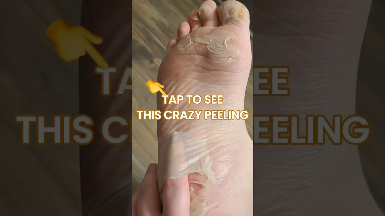 Crazy Peeling Results after Using the Plantifique Foot Peel Mask | Safe Dermatologist Tested Formula