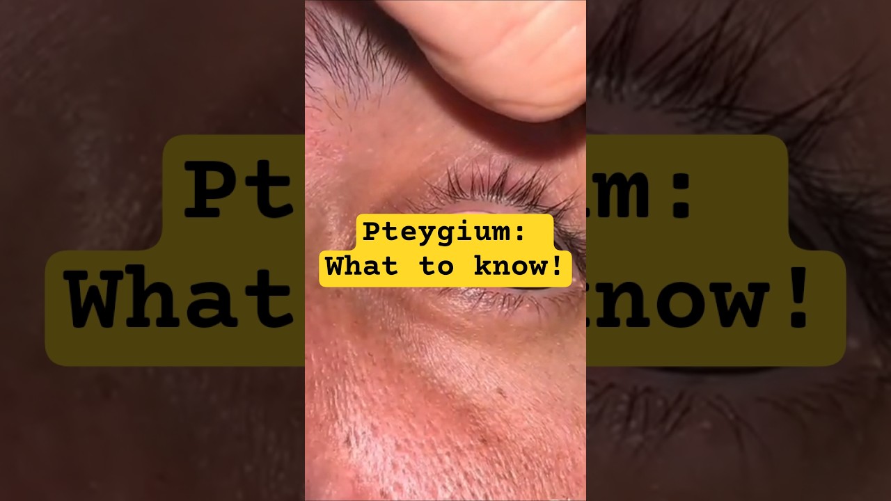 Pterygium: What to know about it.   #pterygium #surferseye