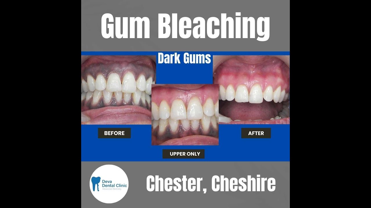 Laser Gum Whitening  Depigmentation Chester, Uk
