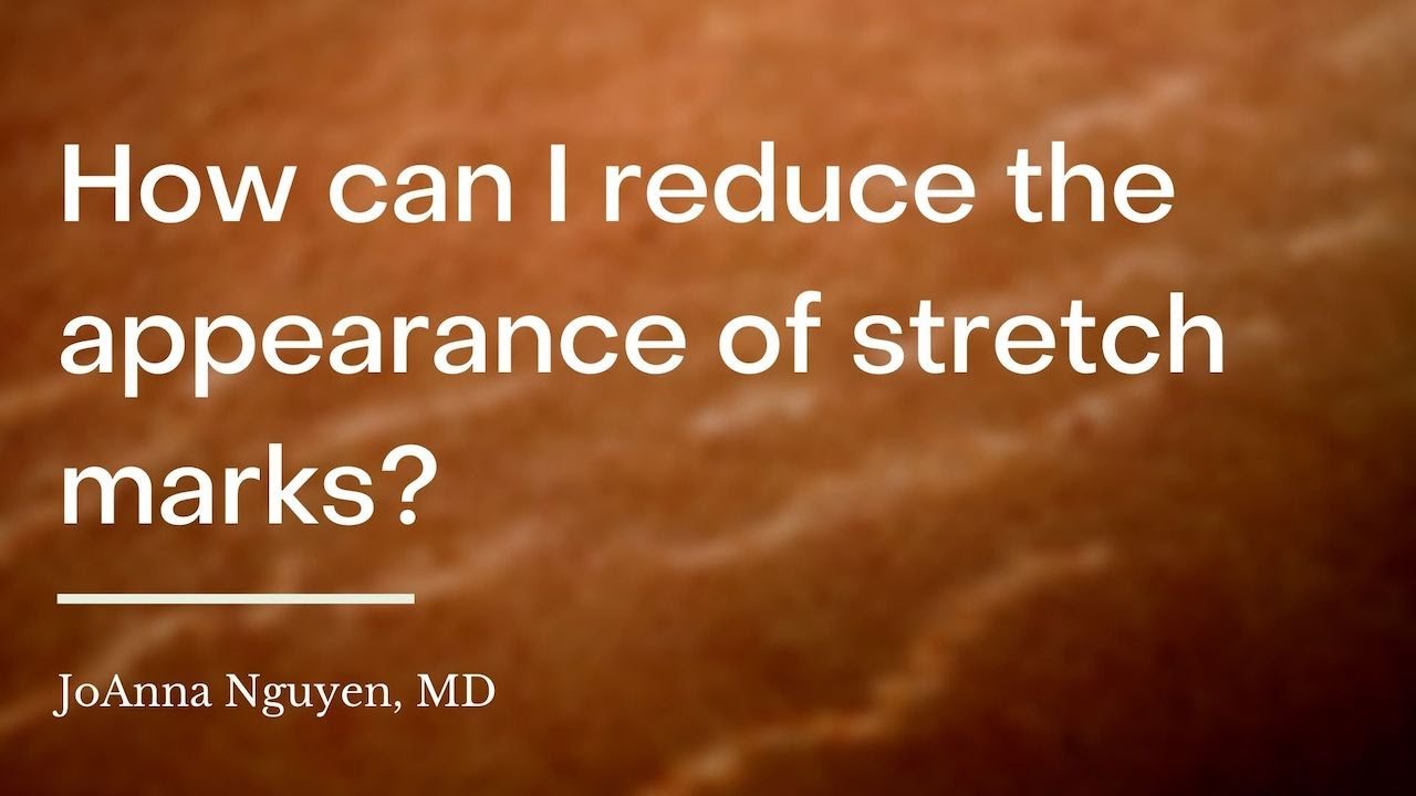 How can I reduce the appearance of stretch marks?
