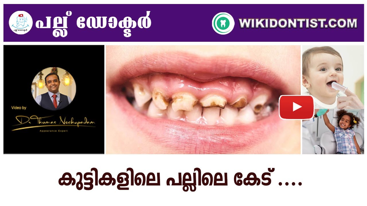 കുട്ടികളിലെ പല്ലിലെ കേട് ....  / Tooth Decay in Children.../ Dr.Thomas Nechupadam