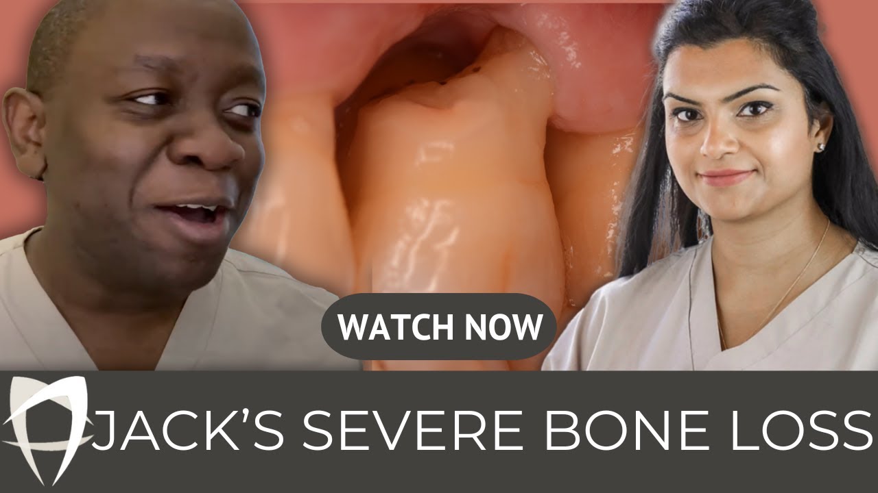 Severe bone loss around a molar tooth