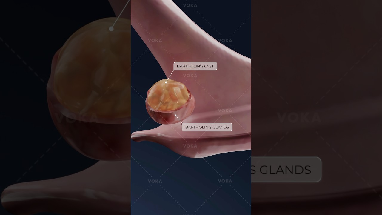 What is a Bartholin cyst and how does it affect women&rsquo;s health? Gynecology in 3D with VOKA!
