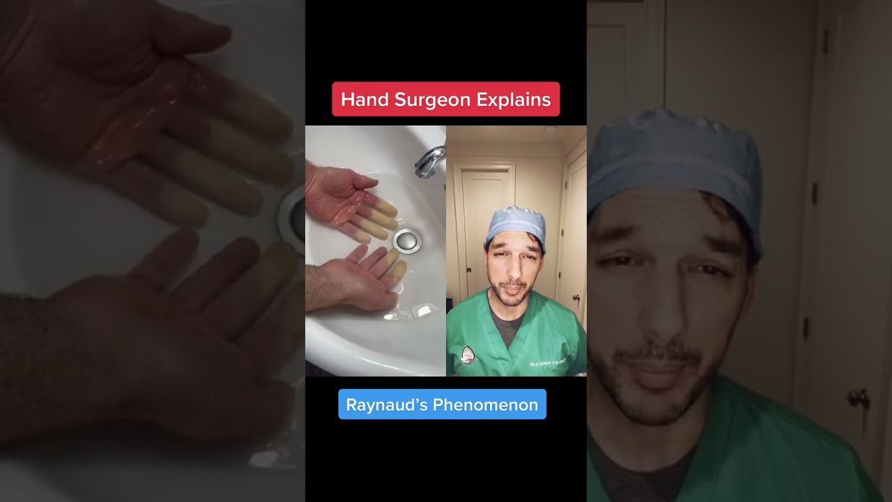 Hand surgeon Nick Pappas MD (Metairie, LA) discusses Raynaud&rsquo;s phenomenon #Raynauds #Finger #Medical