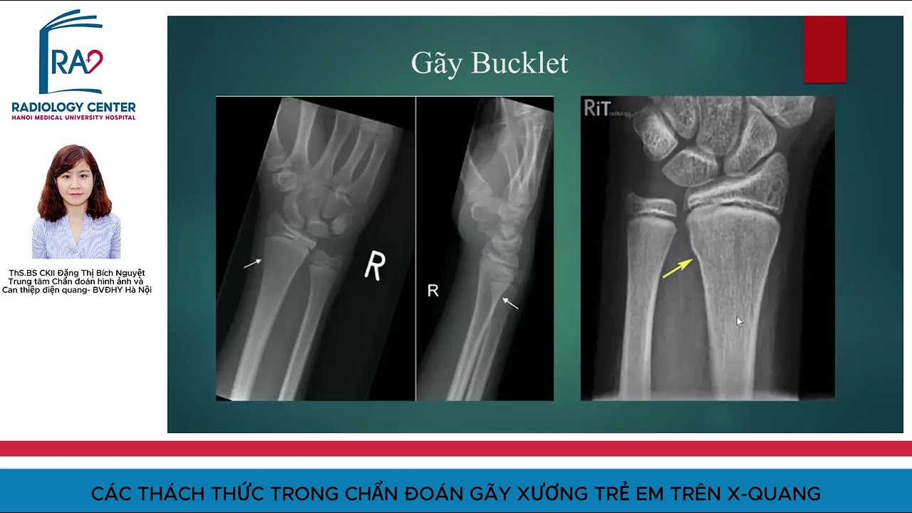 CÁC THÁCH THỨC TRONG CHẨN ĐOÁN GÃY XƯƠNG TRẺ EM TRÊN X- QUANG