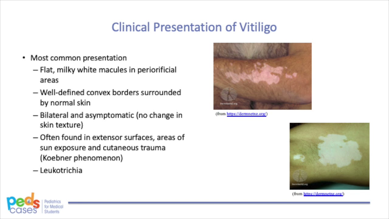Approach to Pediatric Vitiligo Video