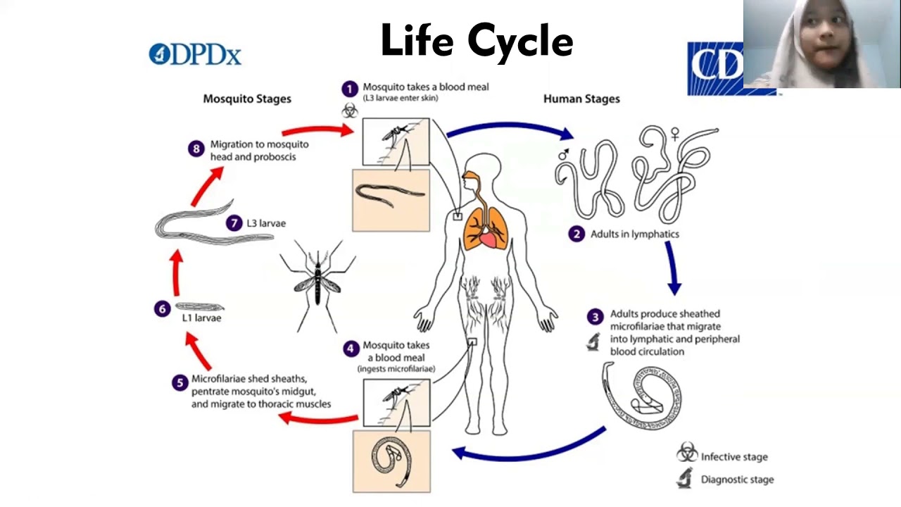 Filariasis (Definition, Risk Factor, Life Cycle, Clinical Features, and Histopathological Findings)