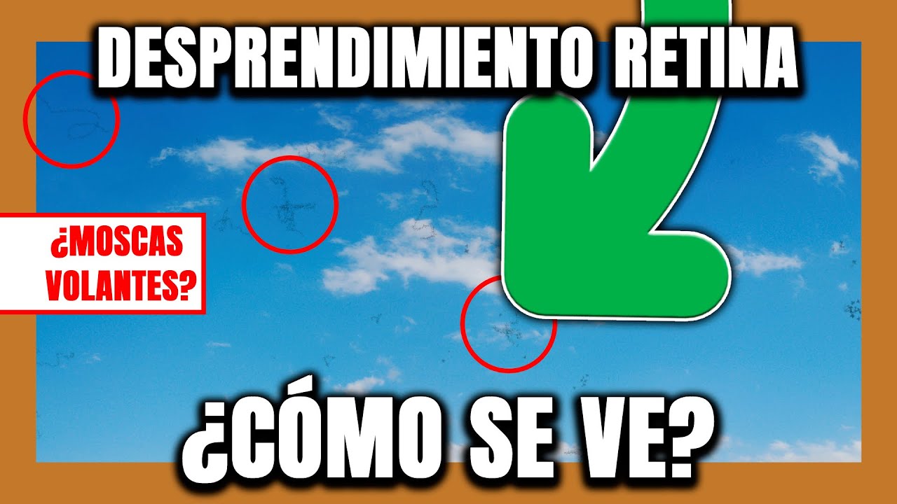 🟠 &iquest;C&oacute;mo VE una persona con DESPRENDIMIENTO de RETINA? #2