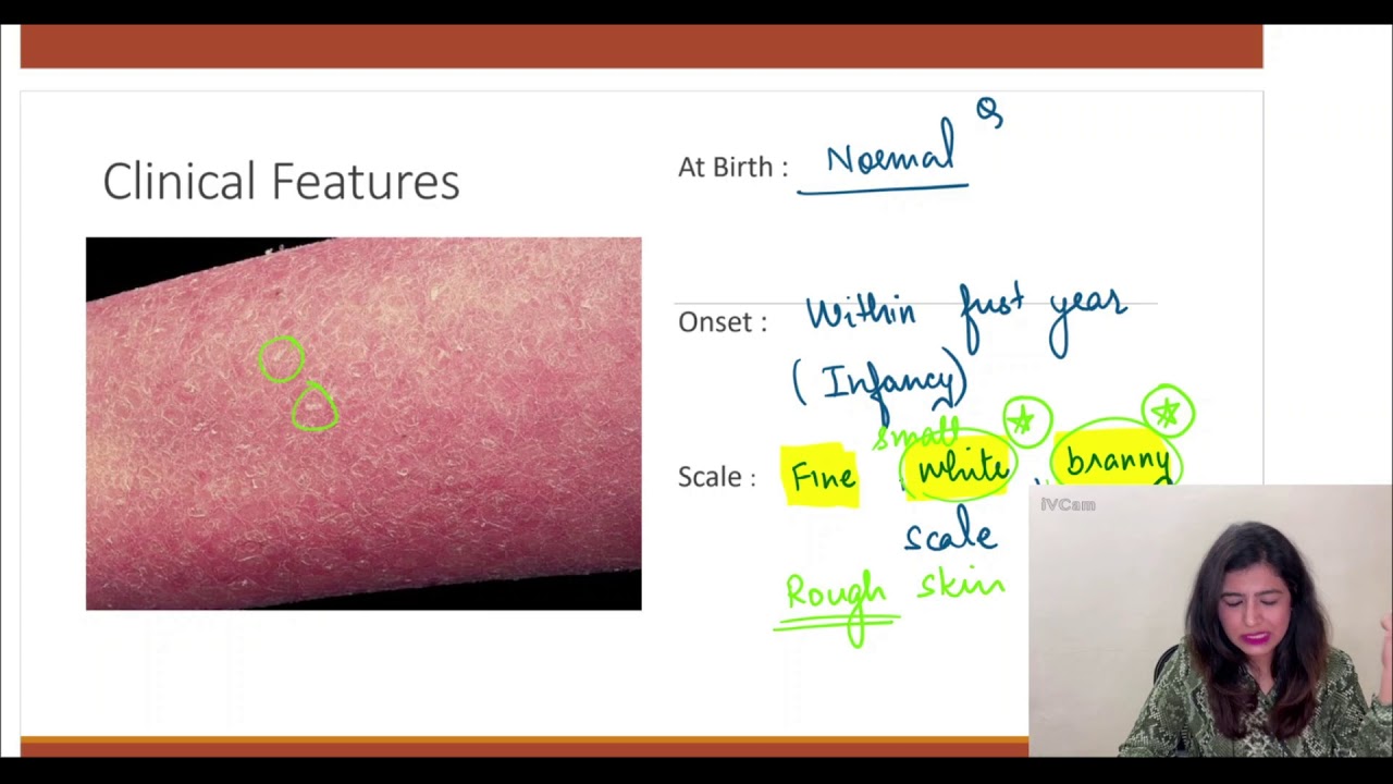Ichthyosis, Cause, Clinical features, Diagnosis & Treatment , Disorder of Keratinisation, Dr Pallavi
